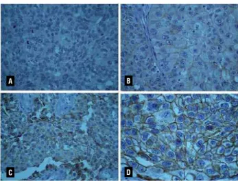 Figure 1 - Examples of the subjective analysis of the intensity  of immune expression that was considered as negative (A),  weak (B), moderate (C) and strong (D).