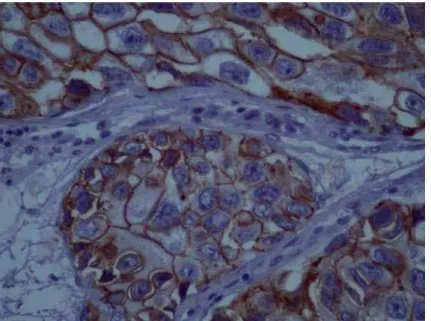 Figure 2 - Micrography of an IHC reaction showing strong expression of E-cadherin.