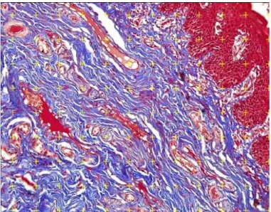 Figure 1 - Photomicrography showing the morphometric analysis of the foreskin.  Quantification of vascular density of the  foreskin in a 23 years old smoker using the image J Test Grid software