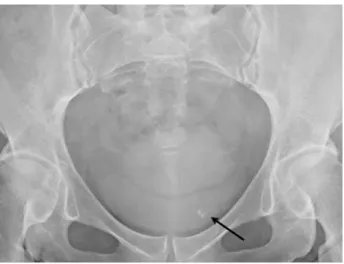 Figure 1 - The plain KUB at postoperative 29 months showed  a small irregular round radiopaque material (black arrow) at  left lower pelvis which was not seen on the postoperative 1  week film (not shown).