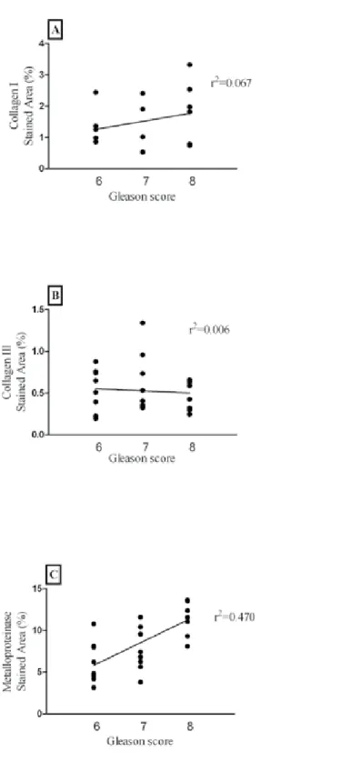 Figure 8 - Linear regression analysis between collagen I (A), III (B) and metalloproteinase (C) expression and Gleason score  in tumor areas