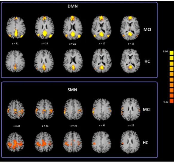 Figure 2 Cortical representation of two group level RSNs (DMN and SMN) in MCI patients and HC