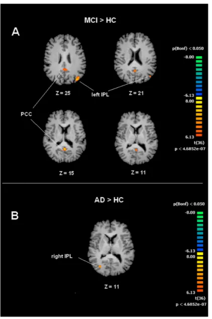 Figure 3 Between group differences in DMN for MCI patients and Healthy controls (HC). Panel (A) shows t-maps obtained when comparing MCI and HC