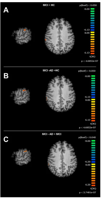 Figure 4 Between group differences in SMN for MCI patients and Healthy controls (HC). Figure depicts t-maps obtained when comparing MCI and HC (A), MCI-AD converted and HC (B) or MCI-AD converted and MCI (C)
