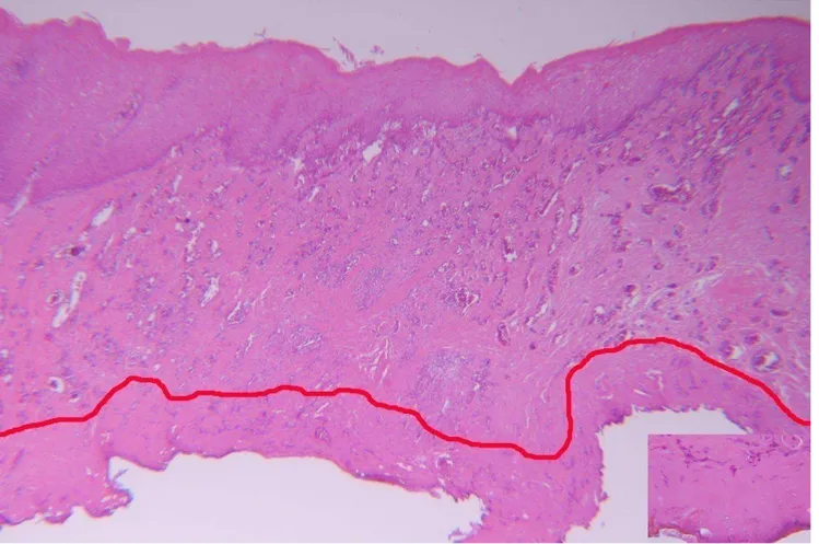 Figure 2- Fragment of fibrous hyperplasia submitted to diode laser surgery. An oral mucosal fragment with hyperplastic stratified squamous epithelium and   lamina  propria  can  be  observed,  represented  by  densely  collagenized  connective  tissue  and