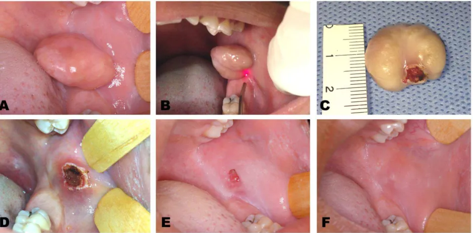 Figure 1  - Clinical aspects of fibrous hyperplasia (HF) after having undergone diode laser surgery