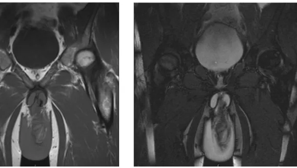 Figure 1 - Coronal T1 image shows disruption of the low  intensity inferior left tunica albuginea and associated low  signal corpus cavernosal hematoma at the base of the penis.
