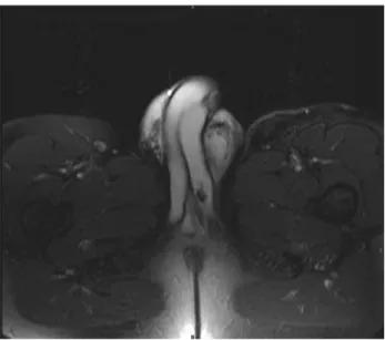 Figure 3 - Coronal T2 image shows disruption of the linear  low signal left tunica albuginea at the base of the penis with  associated heterogeneous hemorrhage medially.