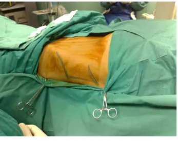 Figure 2 – Amplatz sheath was positioned after tract  dilatation.