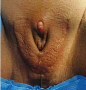 Figure 6 - Genital appearance 6  weeks after first surgery.