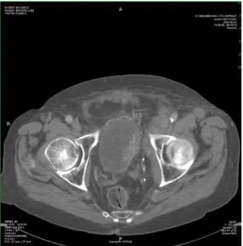 Figure 1 - CT shows extension of enhancing tumor compo- compo-nents into the left perivesical space and anteriorly into the  space of Retzius.