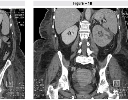 Figure 1 - Initial CT scan showing perfusion changes consistent with bilateral renal vein thrombosis  and a heterogeneously enhancing solid mass with cystic components of left kidney.