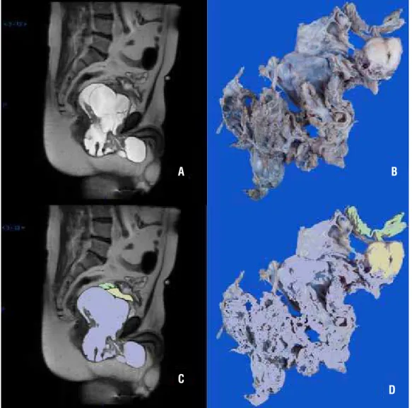 Figure 1 - (A) MRI T2 Sagittal view (B) Macroscopic pathological specimen (C and D) MRI and macroscopic pathological  specimen in colors