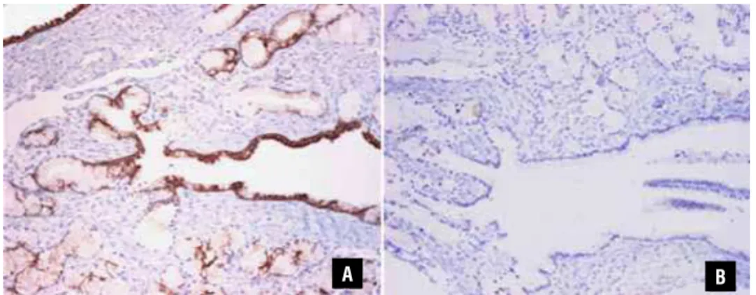 Figure 4 - Immunohistochemistry. (A) High molecular weight keratin (34betaE12) is expressed in normal and dilated glands  (10x); (B) while PSA is negative in both (10x).