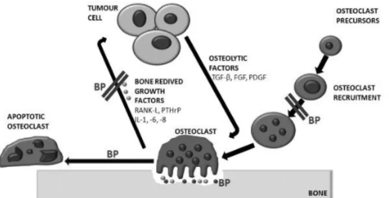 Figure 13. Inhibitory action of bisphosphonates in the vicious cycle of osteolytic metastasis