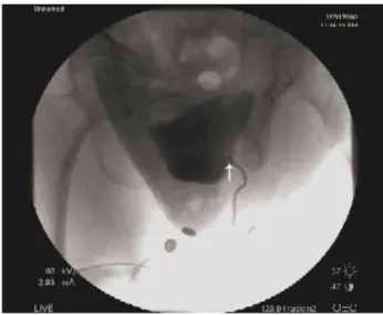 Figure 3 - Demonstrates chain angulation from a VCC test  that is consistent with obstruction