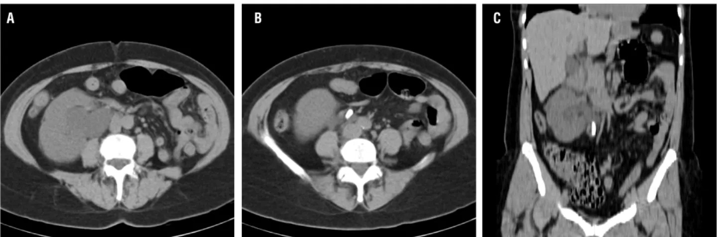 Figure 2 - Ureteroscope deflection in distal ureter.