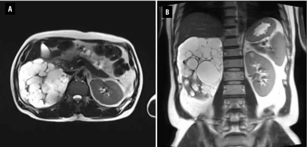 Figure 2 - Postoperative axial (A) and coronal scan (B) of the kidney MRI (T2 weighted image) showing multiple cysts in the  right kidney