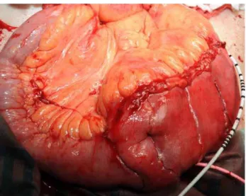 Figure 1D - A sphere-shaped pouch is created.