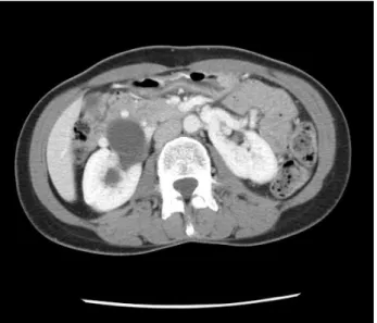 Figure 1 - CT scan demonstrating right UPJ obstruction of a  horseshoe kidney.