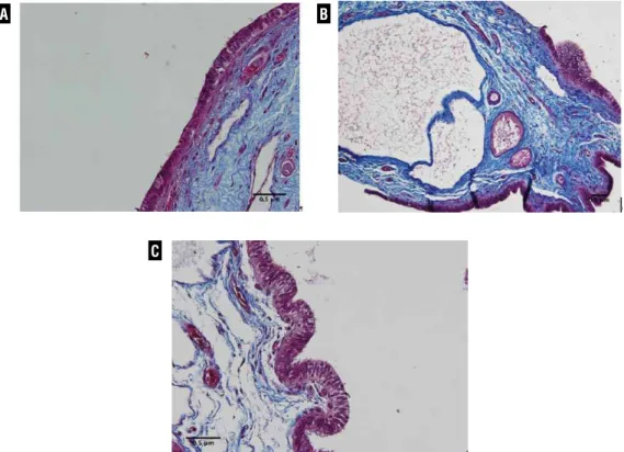 Figure 1 - Appendix epithelium. A) Patient with cryptorchidism with 3-years-old, showing the vascular stroma lined with pseudos- pseudos-tratified epithelium of the testicular appendix