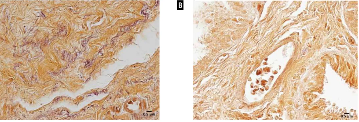 Figure 2 - Elastic system fibers of the testicular appendix. A) Testicular appendix of 13-year-old patient with cryptorchidism