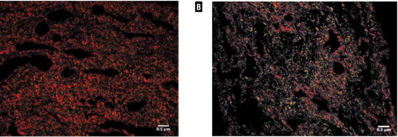 Figure 5 – Qualitative collagen distribution in testicular appendices. A) Testicular appendix of 3-year-old patient with cryptorchidism  showing prevalence of yellowish color