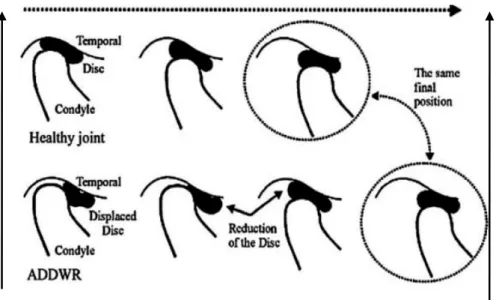 Figura 12: Representação da posição do disco em duas condições. ATM saudável (cima) e  deslocamento anterior com redução (baixo)
