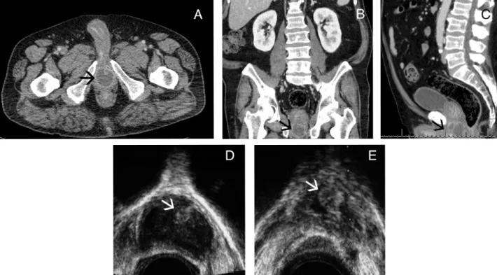 Figure 1 - Panel A) Axial CT-scan of the pelvis demonstrating a rim-enhancing fluid collection (black arrow) at the level of the  proximal bulbar urethra; Panel B) Coronal CT-scan showing the periurethral abscess (black arrow) adjacent to the prostate,  wh