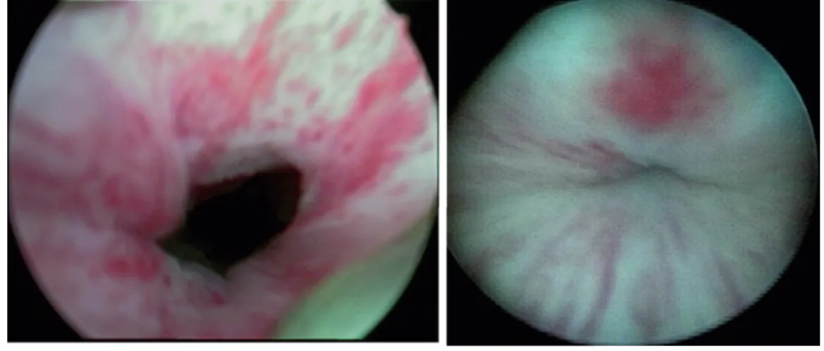 Figure 3 - Left – urethral lumen before the procedure. Right – urethral lumen after RLPP adjust.