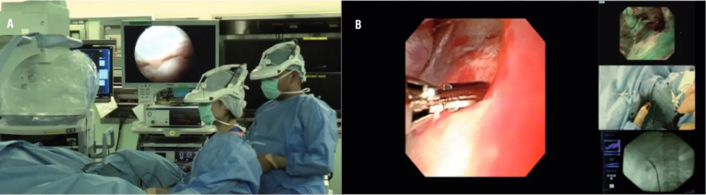 Figure 2 - Photograph of ureteroscopy being performed using the head-mounted display (HMD) system