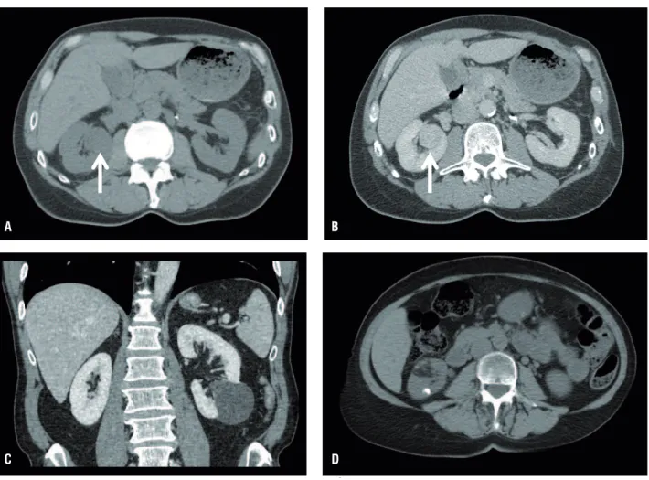 Figure 1 - Exemplary CT scans of renal masses under active surveillance. a &amp; b: solid enhancing renal mass (indicated by  arrows), c: complex cystic mass, d: angiomyolipoma.
