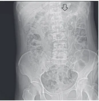 Figure 3 - Computed tomography showing the nephrostomy  tube piercing the renal parenchyma into the left renal vein