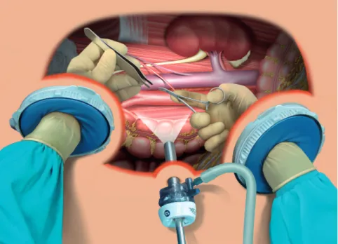 Figure 1 - Both hands have been introduced, the ascending colon has been displaced medially and the lymph node dissection  is been carried out with shorts conventional instruments.