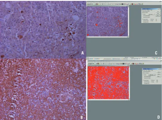 Figure 1 - TF staining in renal cell carcinoma. A) Low staining for TF expression (area < 10µm 2 )  in RCC tumour; B) High intensity of staining for TF (area > 10µm 2 ) in RCC tumour (reduced  from X100)