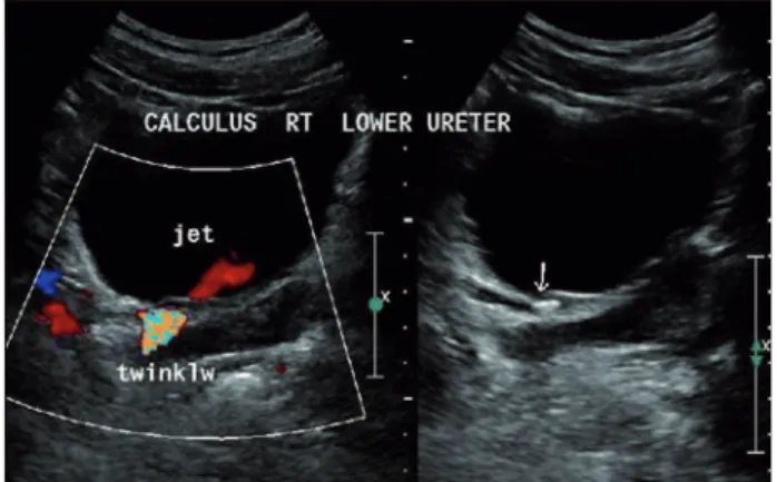 Table 2 - Site and size of ureteral stones by KUB in 939 cases.