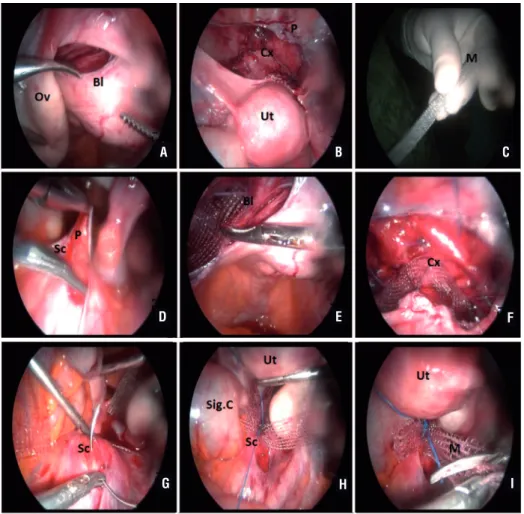Figure 1 - The surgical procedure of Cravat technique. A) Opening of left broad ligament