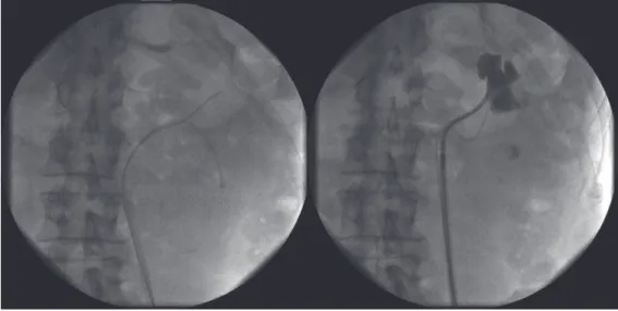 Figure 4 - Arterial bleed was identified in a lower pole calyx at the site where the original percutaneous access was obtained.