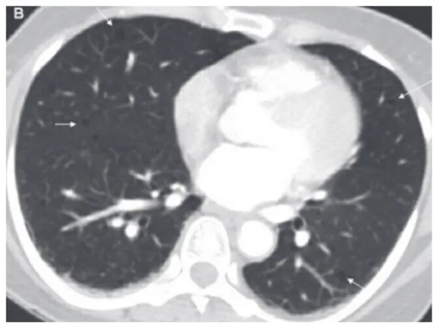 Figure 1 - Multiple diffuse low attenuating cystic masses  with peripheral enhancement.