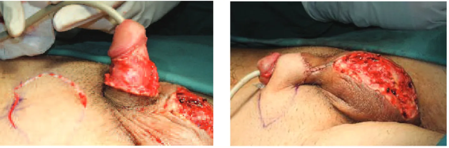 Figure 3 - Ensuring that site and area of flap are  appropriate.
