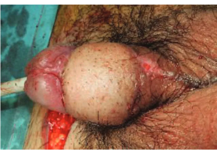 Figure 5 - Flap raised and inset around penile shaft.