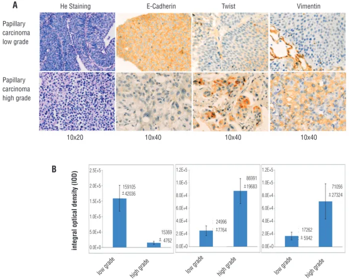 Figure 1 - E-cadherin, Twist and Vimentin expression in bladder cancer. A. Images of immunohistochemically detected  expression