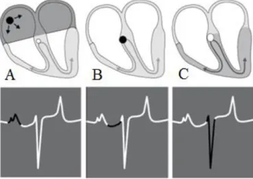 Figura 4: Representação do sistema de condução cardíaco e a relação da propagação do  impulso com um ECG de superfície (adaptado de van Loon &amp; Patteson, 2010)