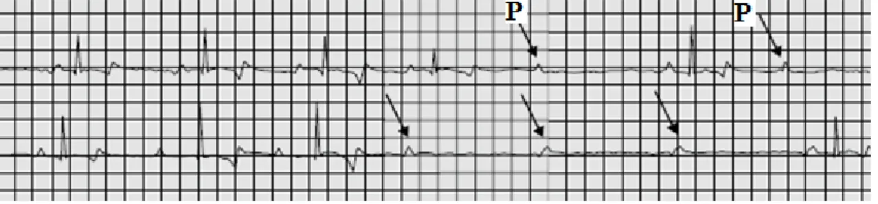 Figura 9: Bloqueio AV de segundo grau avançado onde ocorrem frequentemente séries de ondas  P que são bloqueadas (setas)