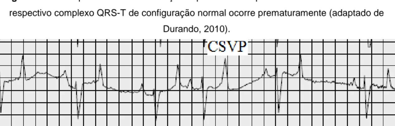 Figura 12: ECG apresenta uma contracção supraventricular prematura onde uma onda P e o  respectivo complexo QRS-T de configuração normal ocorre prematuramente (adaptado de 