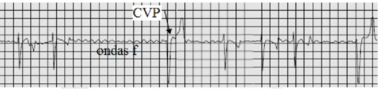 Figura 13: Intervalos R-R irregulares, ausência de ondas P e presença de ondas f. Verifica-se a  presença de um complexo ventricular (seta) e os restantes QRS apresentam uma configuração 