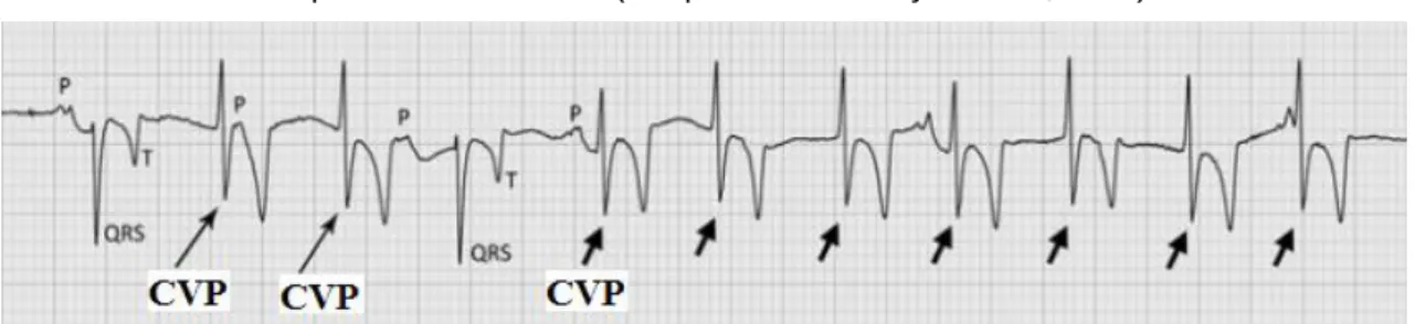 Figura 15: Taquicardia ventricular (setas curtas). Duas CVP (setas longas) precedem um  complexo P-QRS-T normal e um conjunto de contracções ventriculares prematuras em cadeia: 
