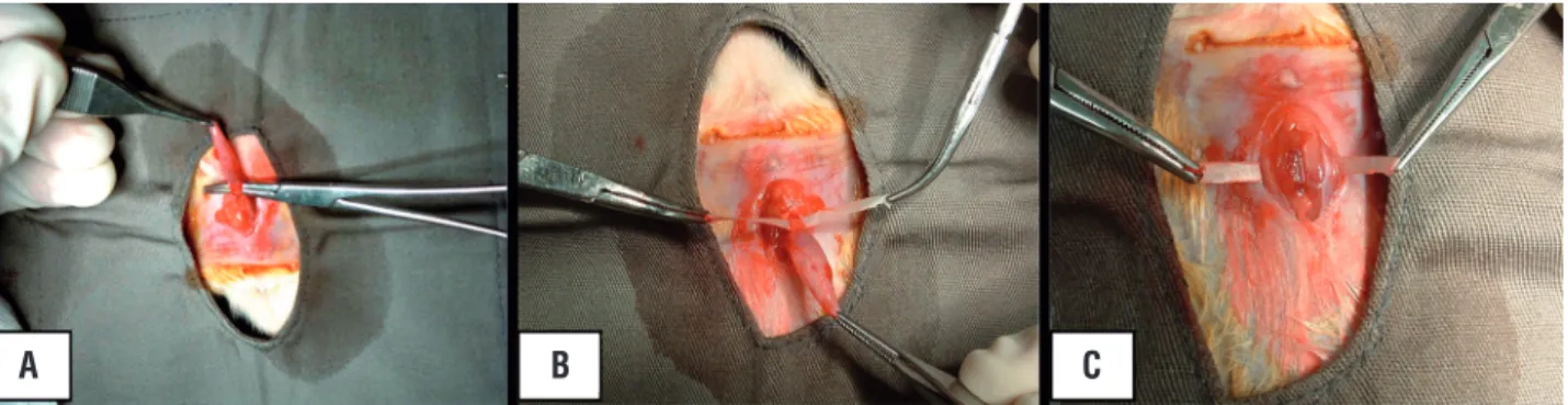 Figure 1 - Surgical technique of implantation showing dissection of the urethra (A), positioning of the CEC  at the suburethral space (B) and fixation to the abdominal wall (C).