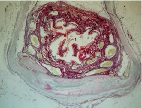 Figure 4 - CEC Sling in the suburethral space (red arrow) (HE, 40X).