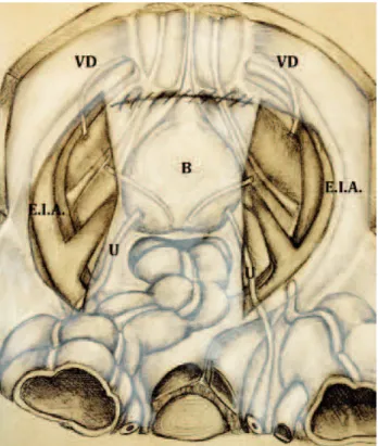 Figure 4 - At the end of the peritoneum suture the peritoneal  cavity and retropubic space do not communicate thanks  to prevesical fascia